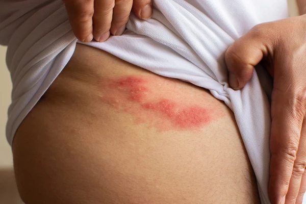 Image for article titled What is Shingles?